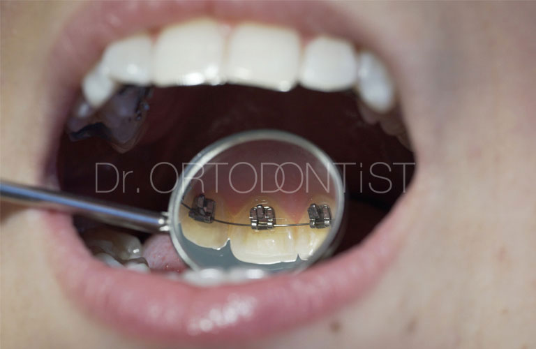 Erişkin Ortodontisinde Estetik Alternatifler